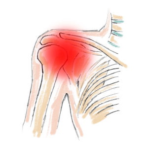 Impingement-Syndrom: Symptome, Ursachen & Lösungen | Flexmate®